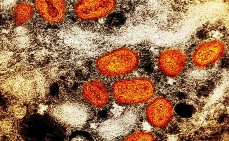 Всичко, което трябва да знаете за епидемията от маймунска шарка